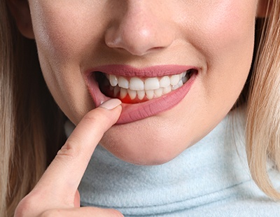 woman pointing to red inflamed gums